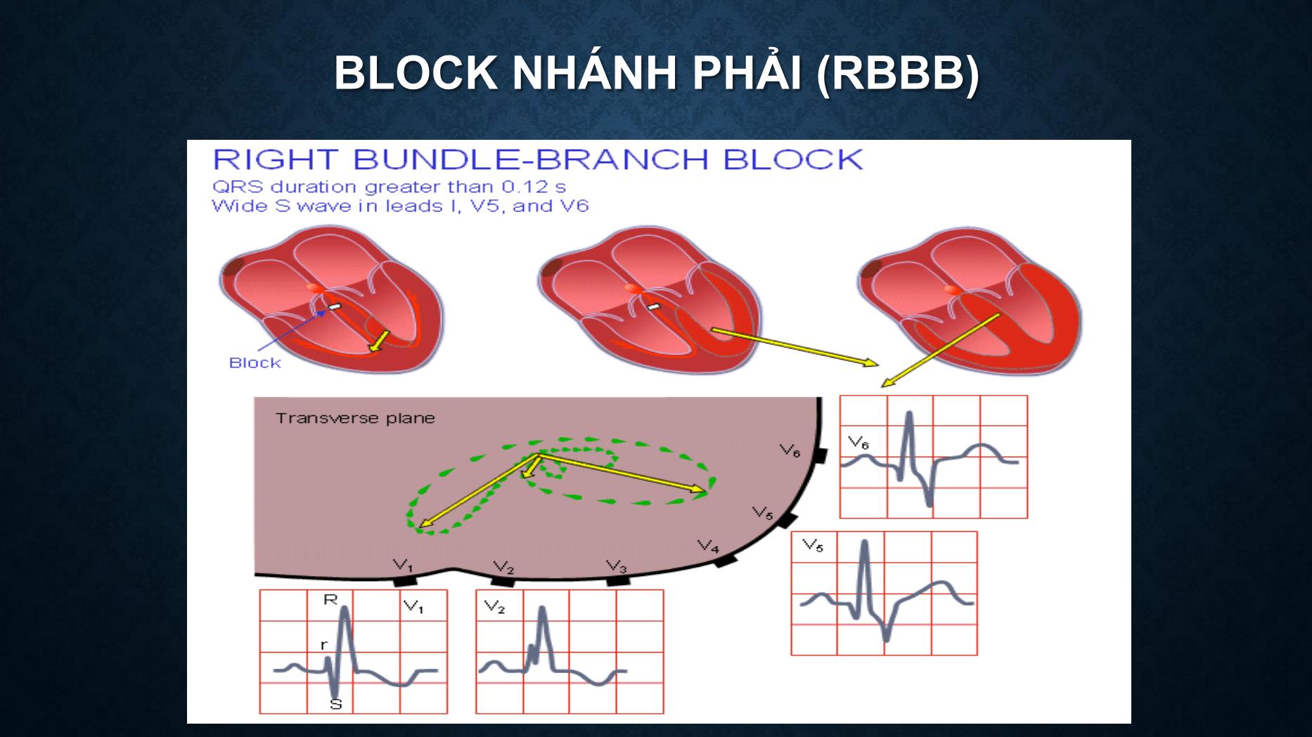 Bài giảng Điện tâm đồ trong rối loạn dẫn truyền tim - Trần Tuấn Việt trang 5