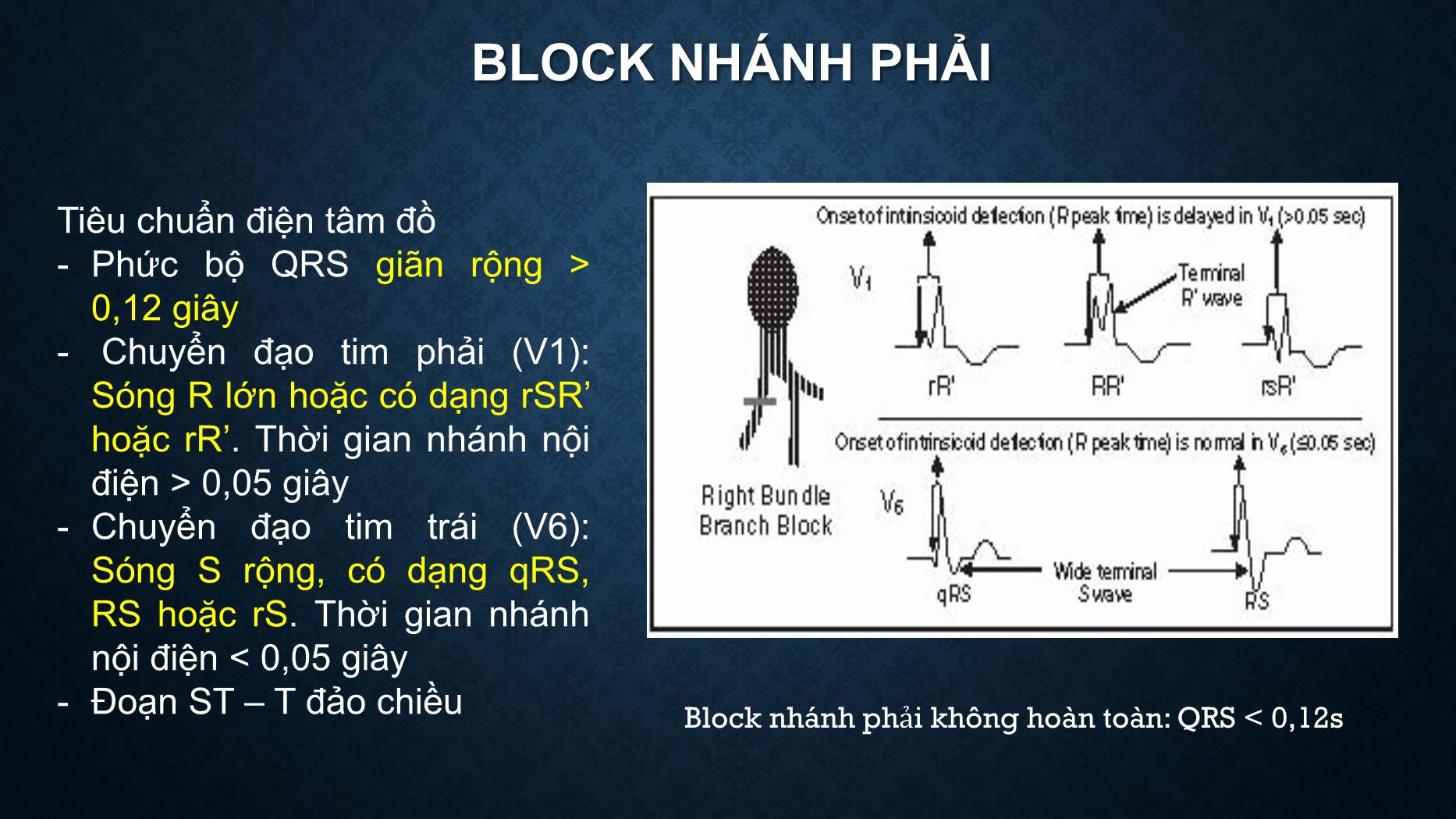 Bài giảng Điện tâm đồ trong rối loạn dẫn truyền tim - Trần Tuấn Việt trang 6