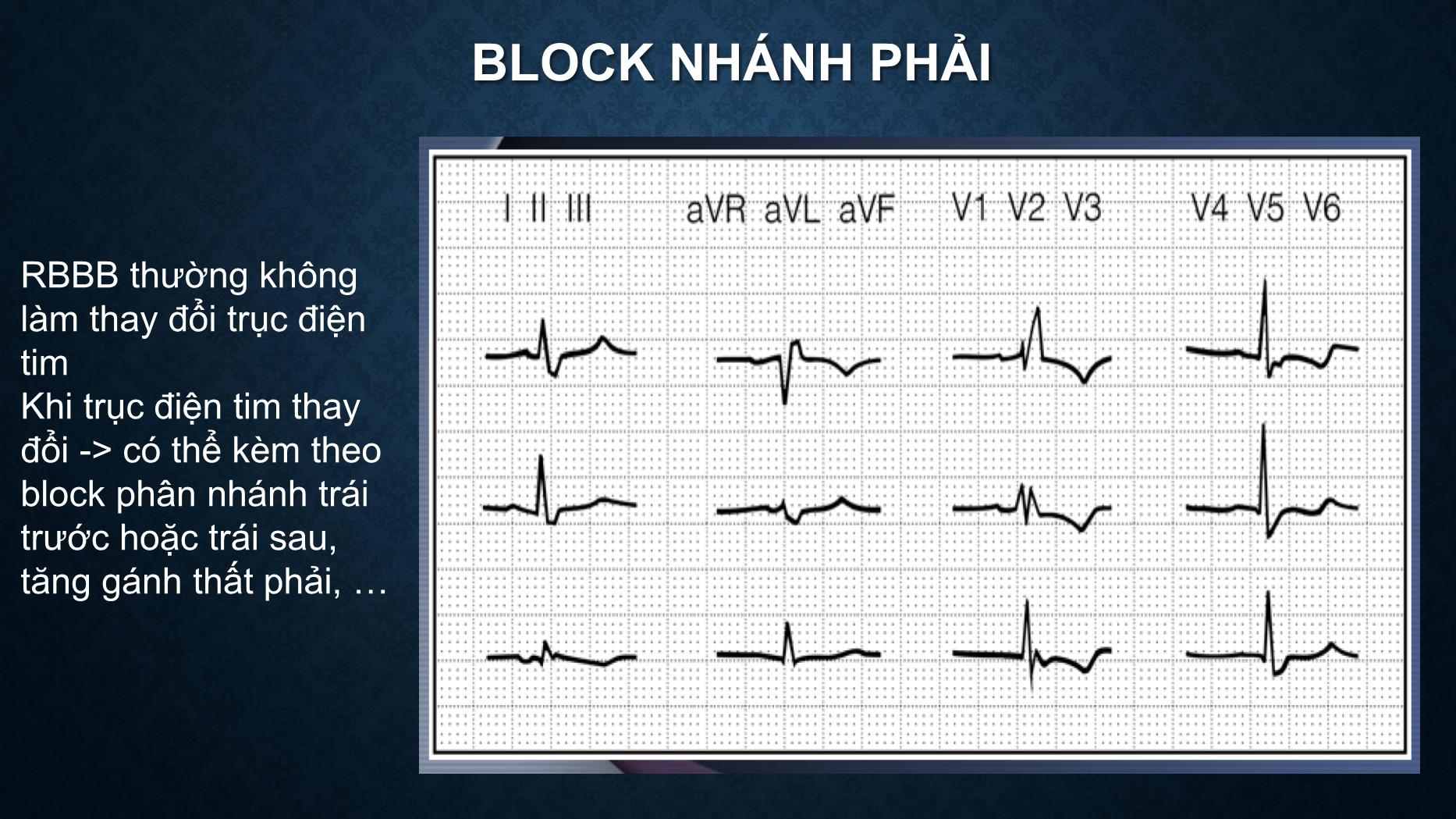 Bài giảng Điện tâm đồ trong rối loạn dẫn truyền tim - Trần Tuấn Việt trang 7