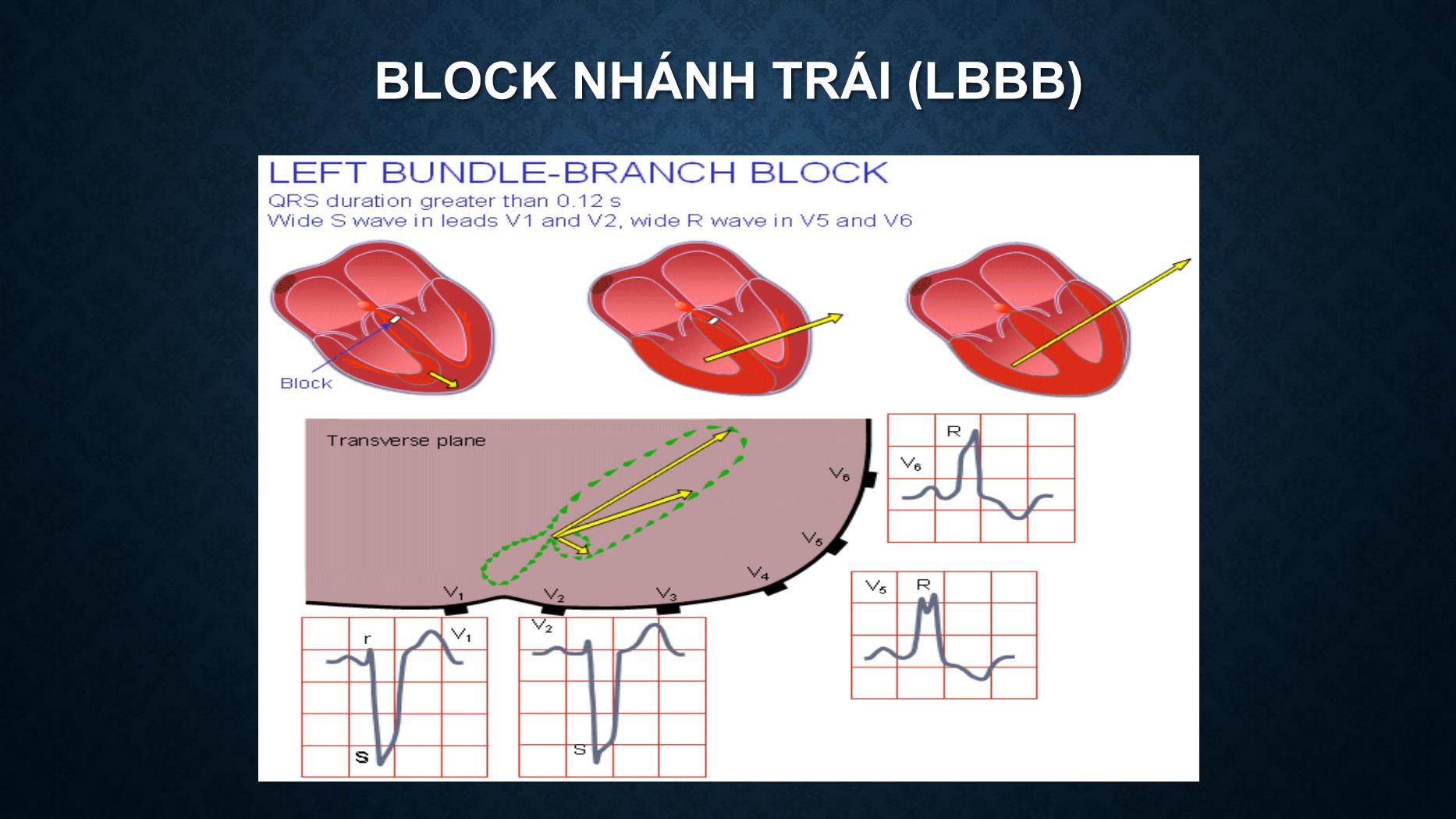 Bài giảng Điện tâm đồ trong rối loạn dẫn truyền tim - Trần Tuấn Việt trang 9