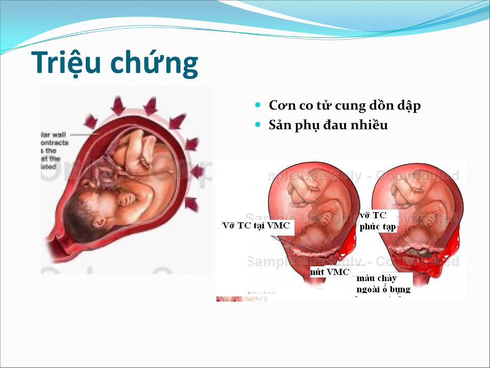 Bài giảng Dọa vỡ - vỡ tử cung - Trần Ngọc Ánh trang 10