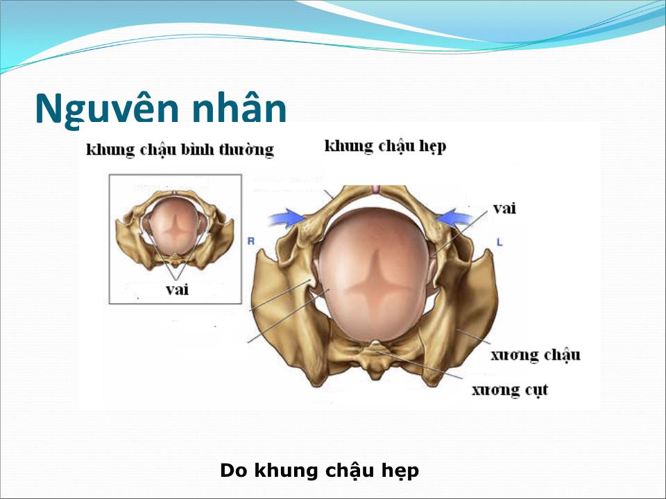 Bài giảng Dọa vỡ - vỡ tử cung - Trần Ngọc Ánh trang 5