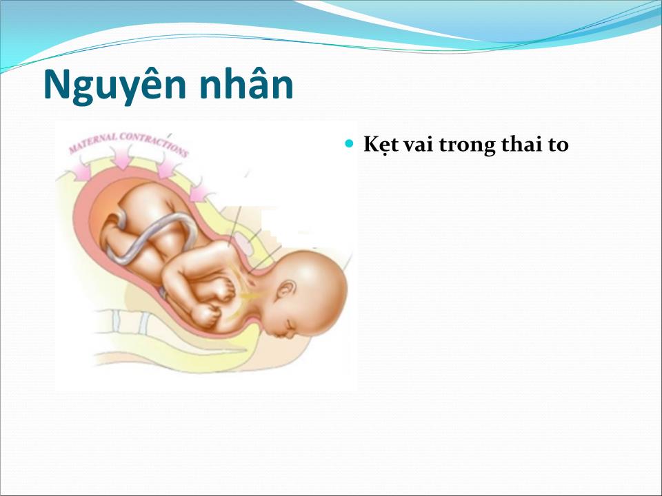 Bài giảng Dọa vỡ - vỡ tử cung - Trần Ngọc Ánh trang 6