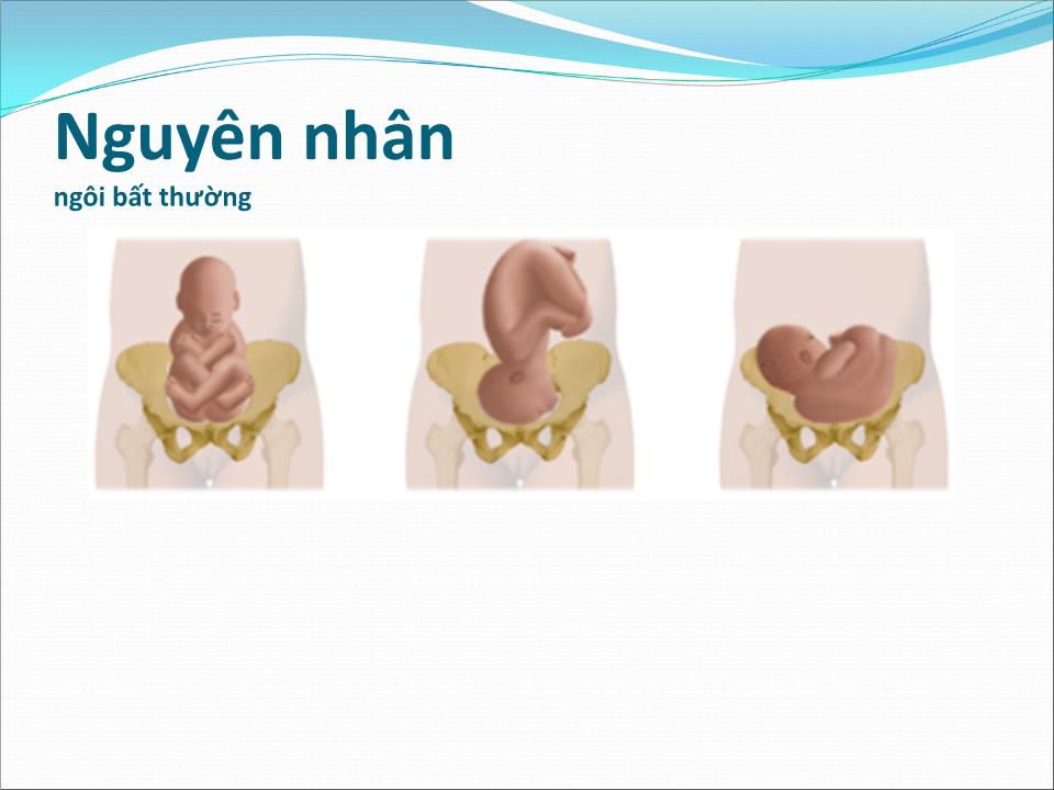 Bài giảng Dọa vỡ - vỡ tử cung - Trần Ngọc Ánh trang 7