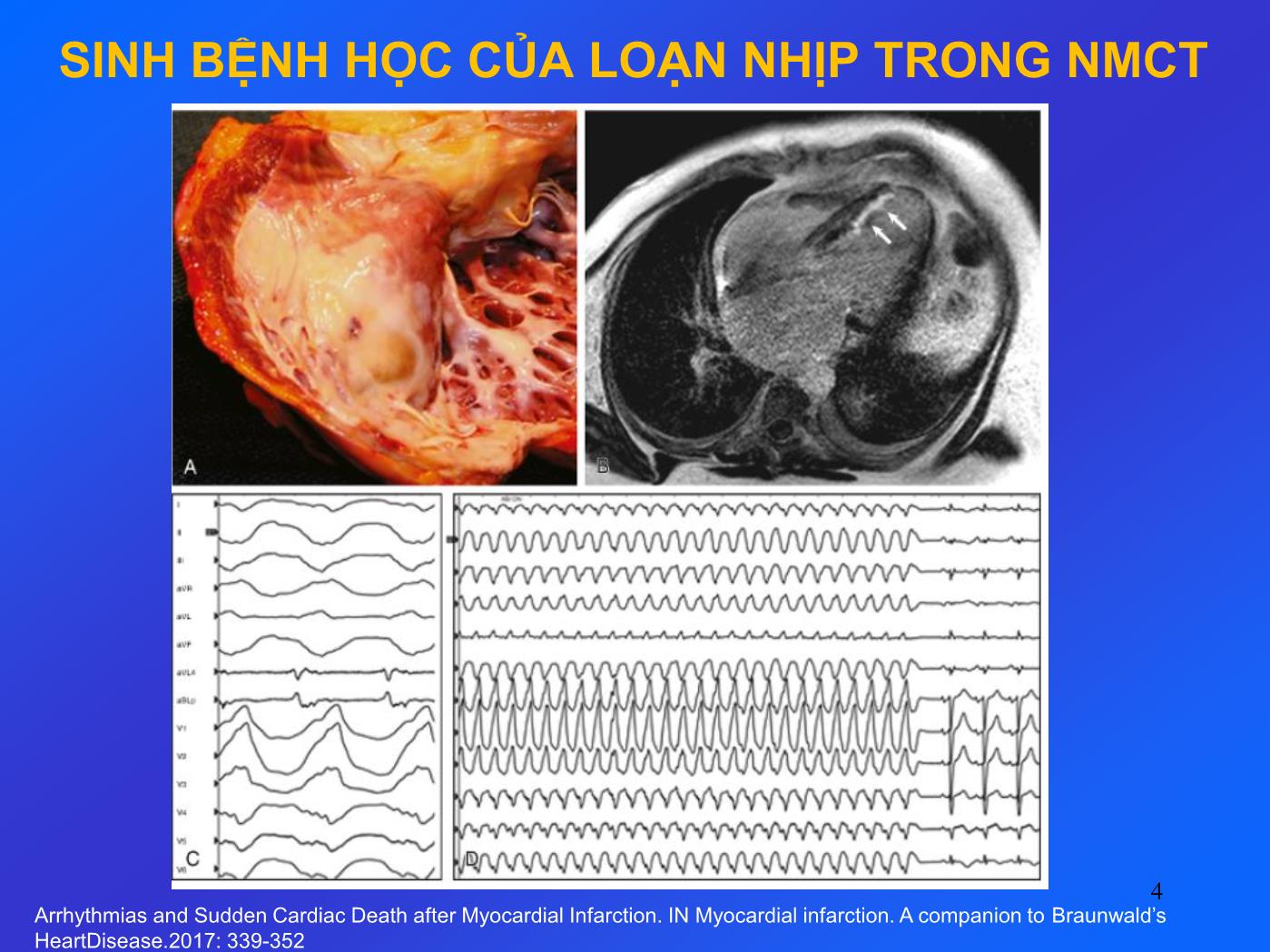 Hội chứng mạch vành cấp với ST chênh lên: Điều trị biến chứng rối loạn nhịp thất - Nguyễn Thanh Hiền trang 4