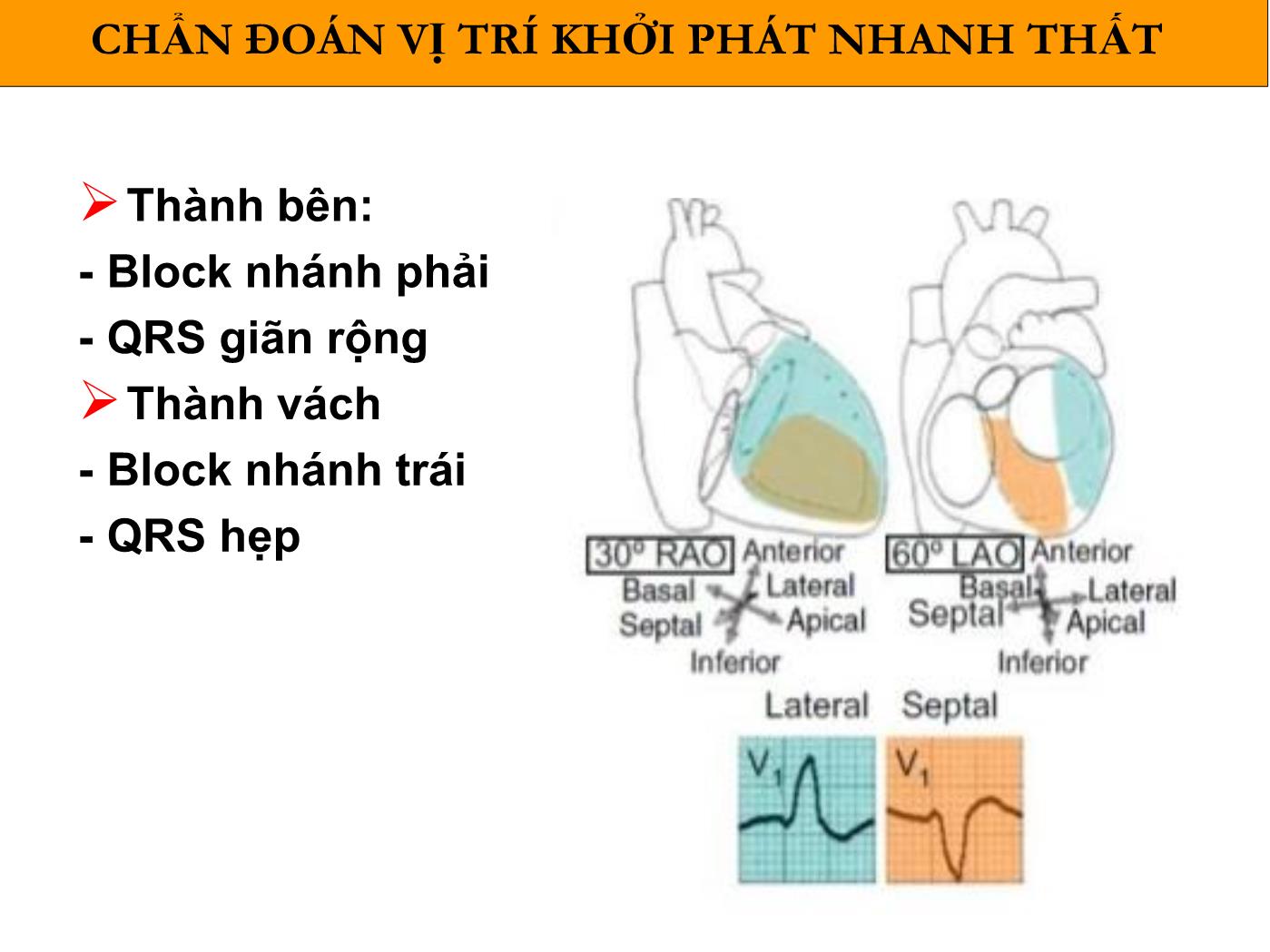 Bài giảng Loạn nhịp thất sau nhồi máu cơ tim - Phạm Trường Sơn trang 9