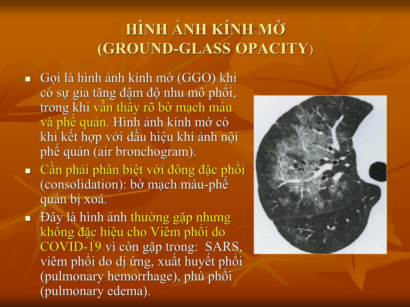 Đề tài Sự liên quan giữa viêm phổi do Covid 19 và ARDS - Nguyễn Qúy Khoáng trang 4