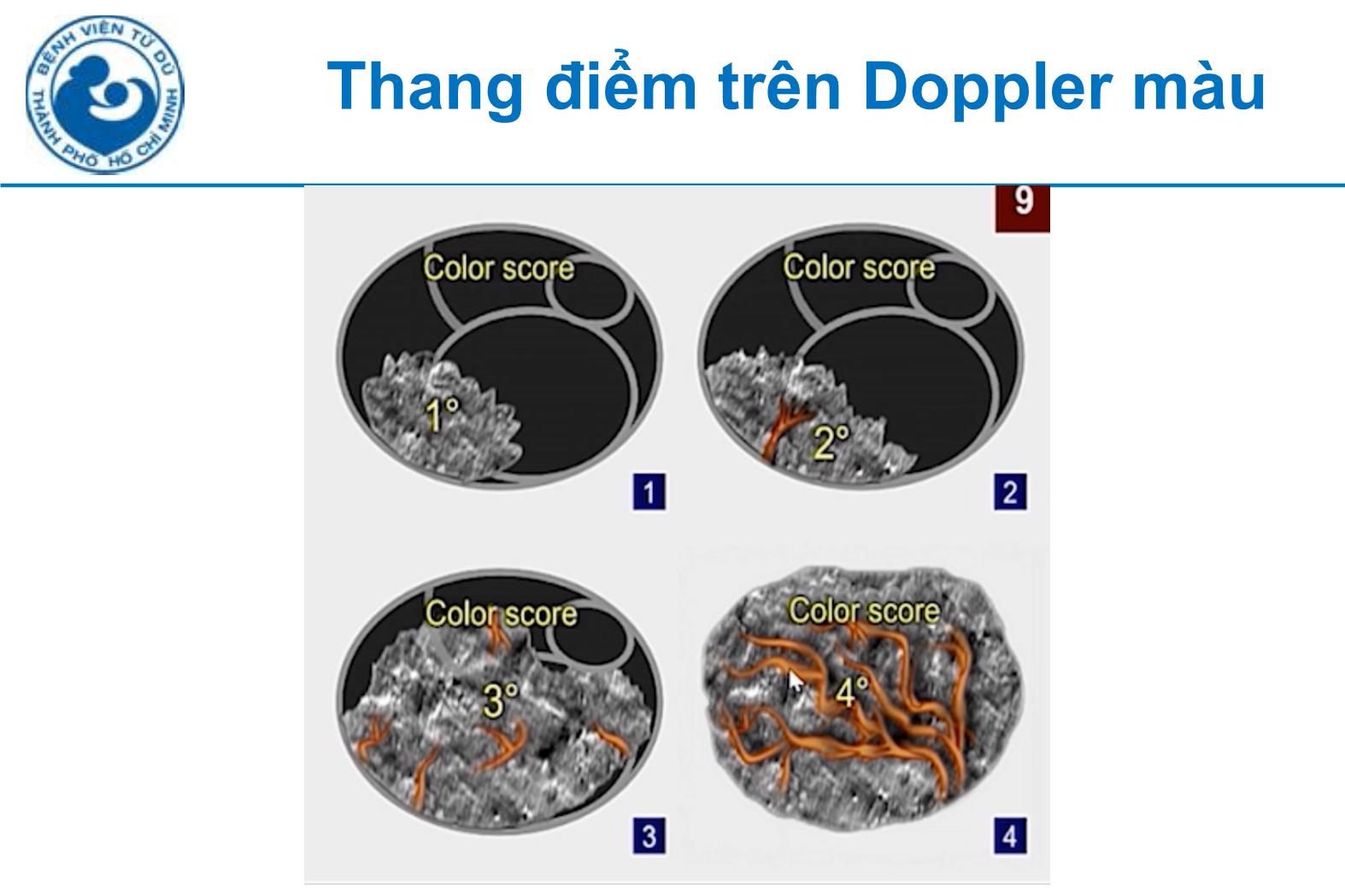 Đề tài Siêu âm đánh giá khối u buồng trứng tính nguy cơ ác tính theo IOTA - Hà Tố Nguyên trang 6