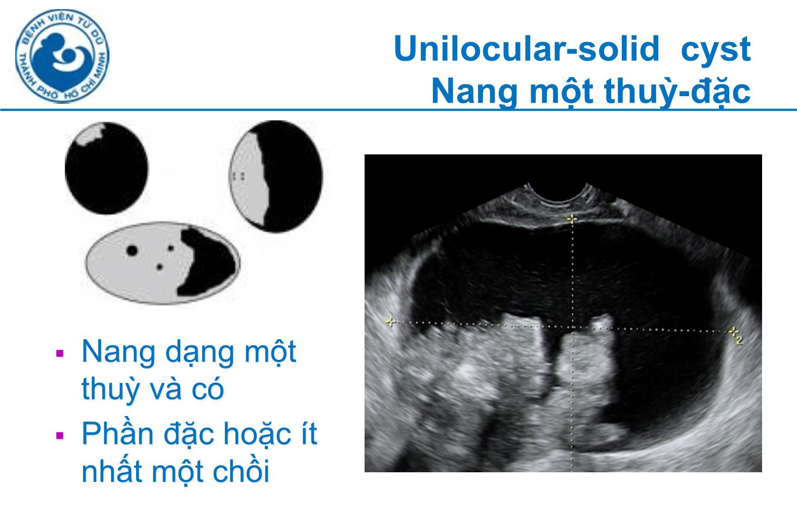 Đề tài Siêu âm đánh giá khối u buồng trứng tính nguy cơ ác tính theo IOTA - Hà Tố Nguyên trang 9